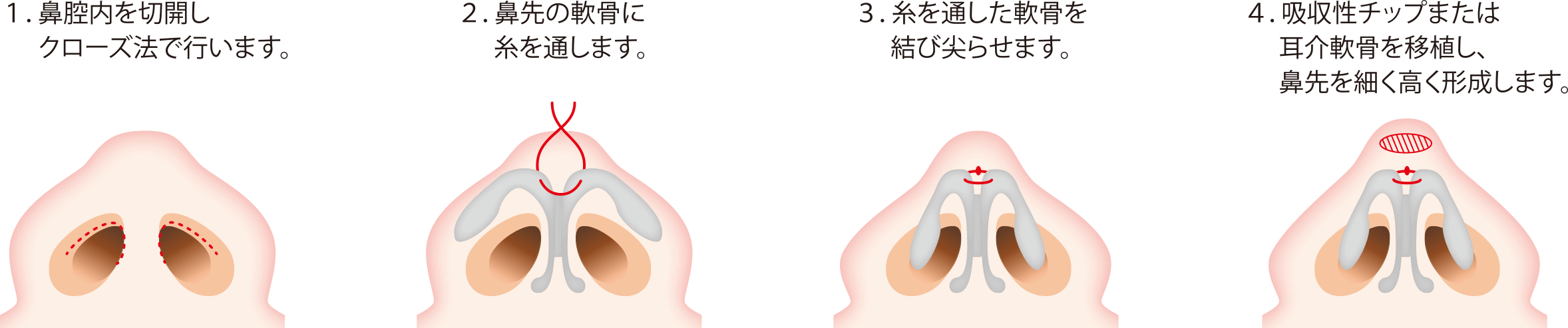 鼻尖形成 施術の流れ
