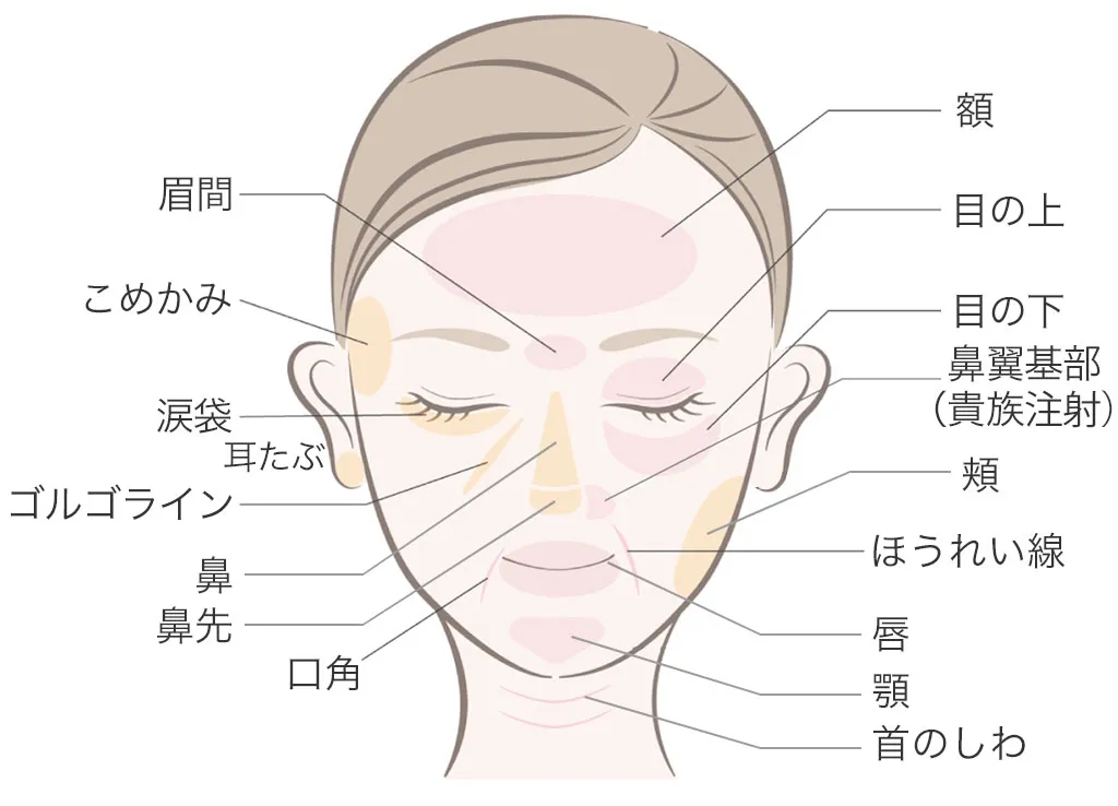 ヒアルロン酸の注入可能な部位のイラスト