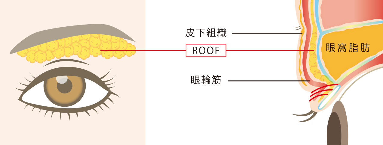 ROOF(隔膜前脂肪)切除